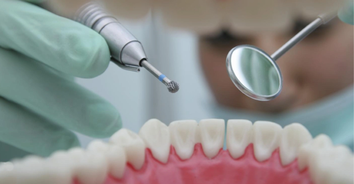 Drill Free Tooth Decay Treatment 2